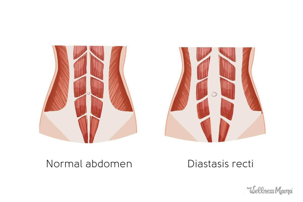 Quelle diastase abdominale ?