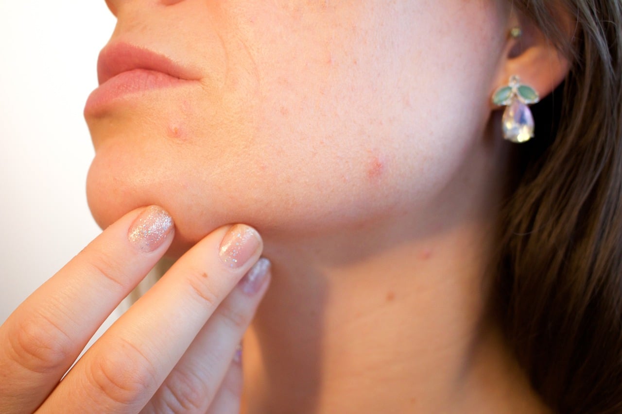 Quel produit efficace permet à un adolescent de lutter contre l’acné du visage ?